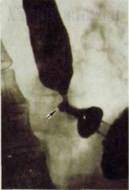 рентгенография желудка с язвой пищевода